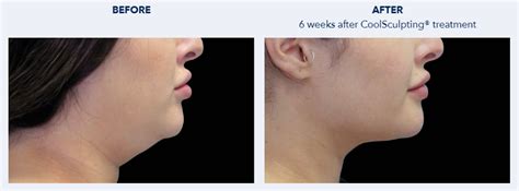 CoolSculpting Manila Cost, Prices, Before and After Photos.